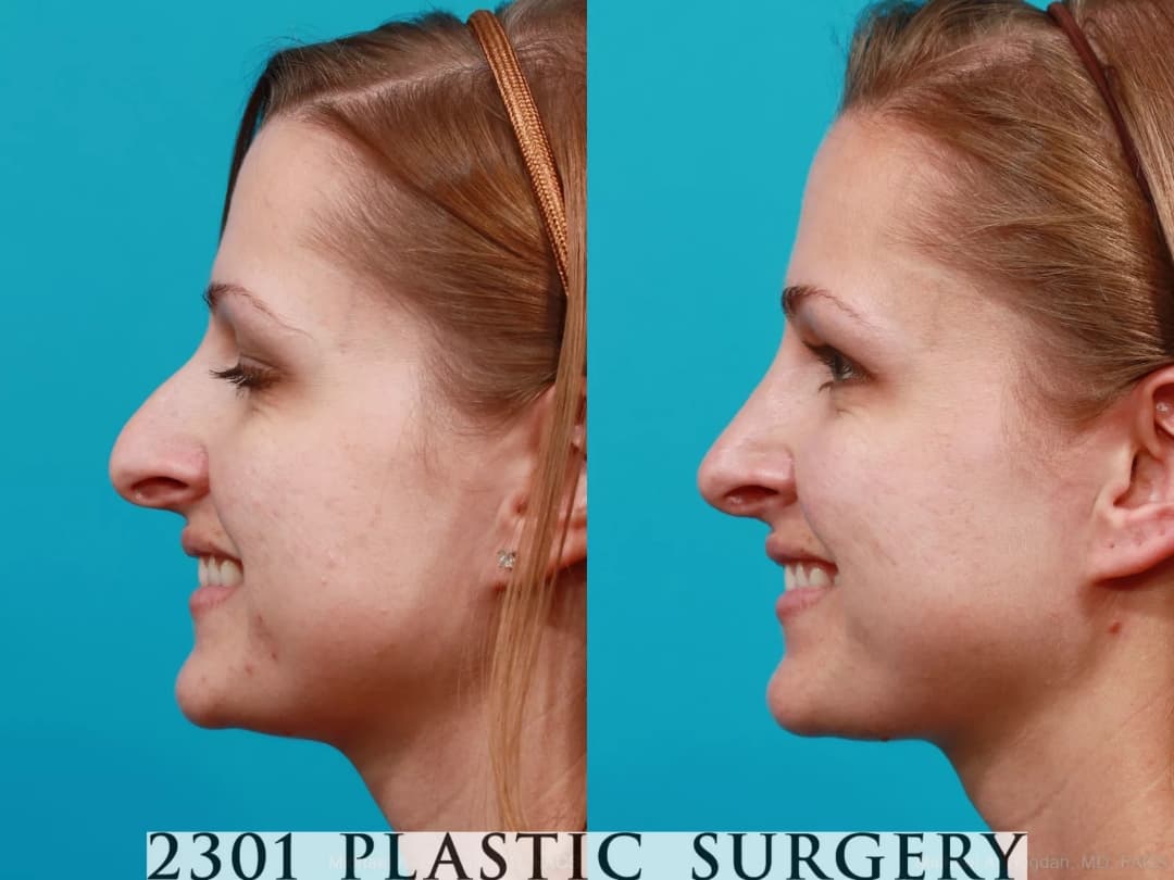 Rhinoplasty Before & After