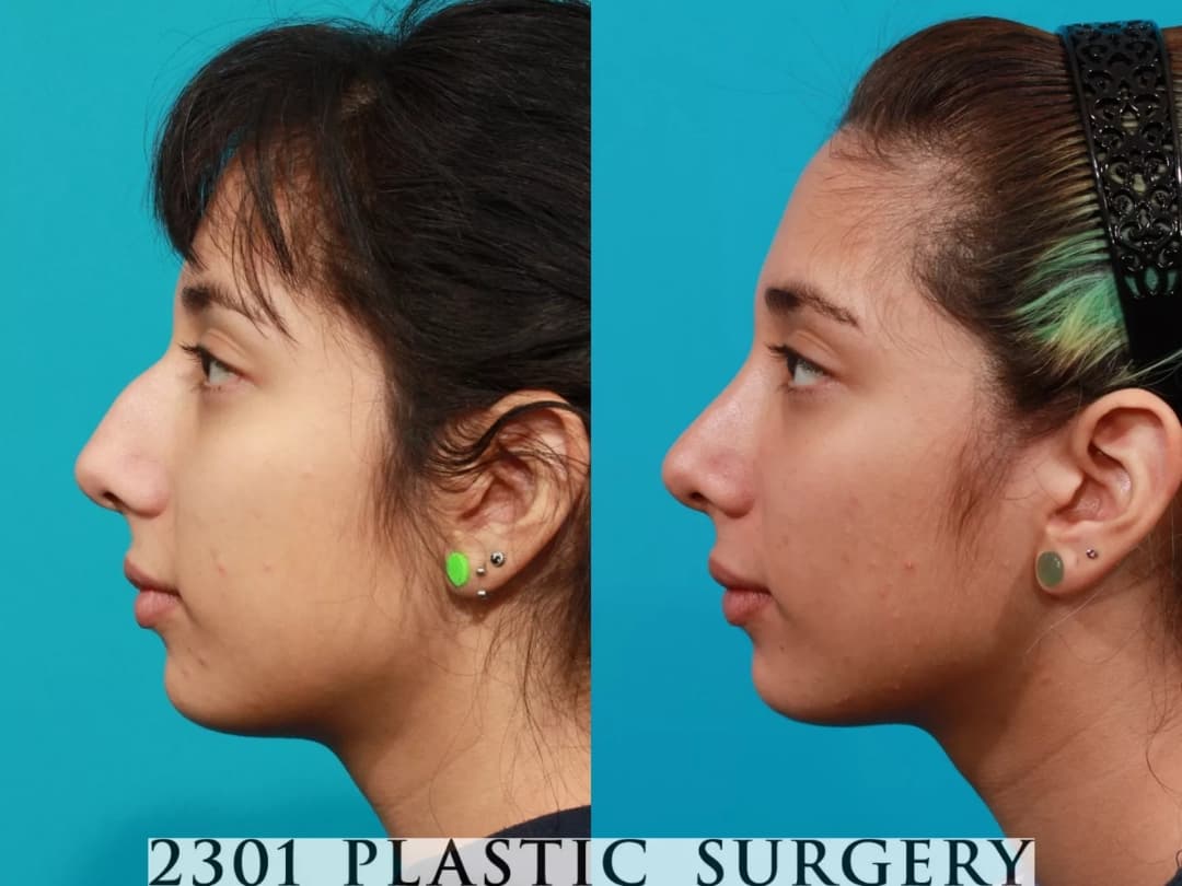 Rhinoplasty Before & After