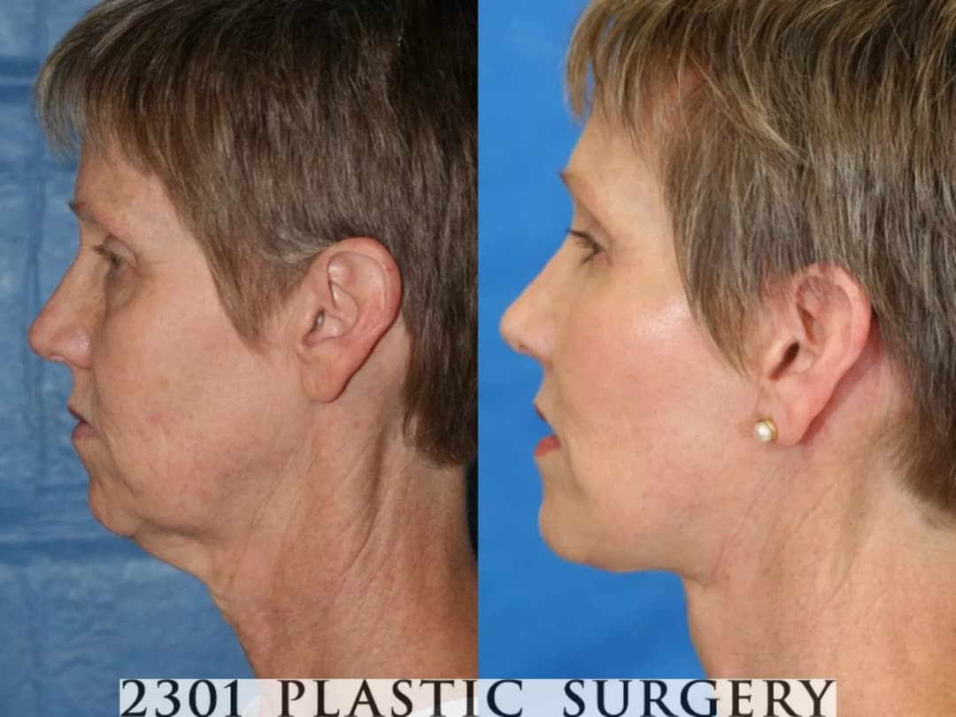 Face Lift Before & After