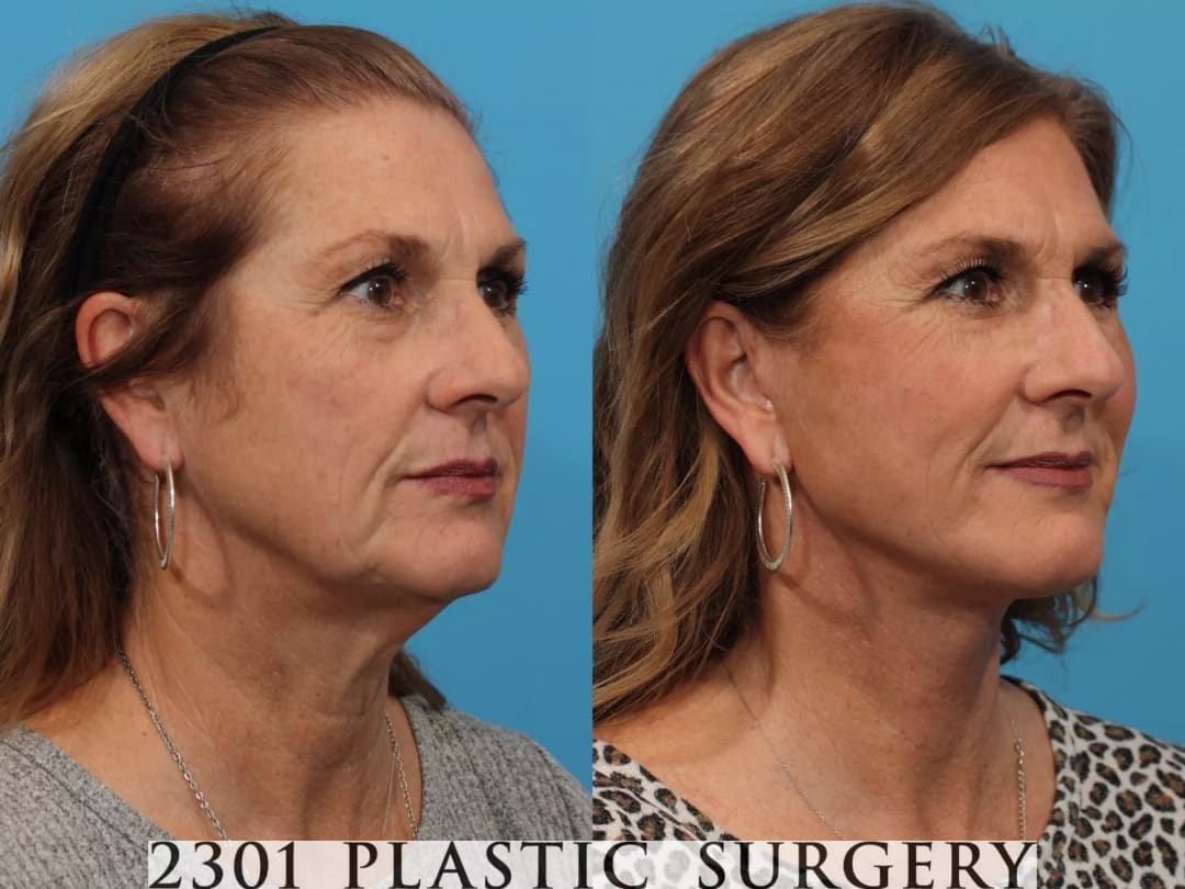 Facelift Before & After