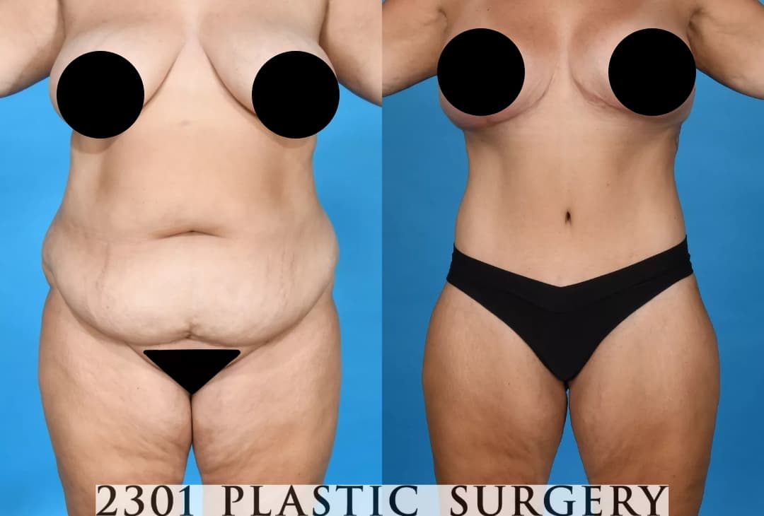 Mommy Makeover Before & After