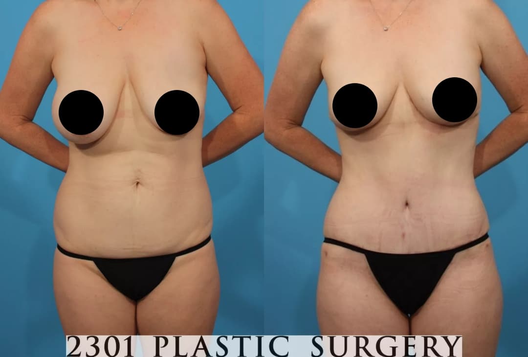 Mommy Makeover Before & After