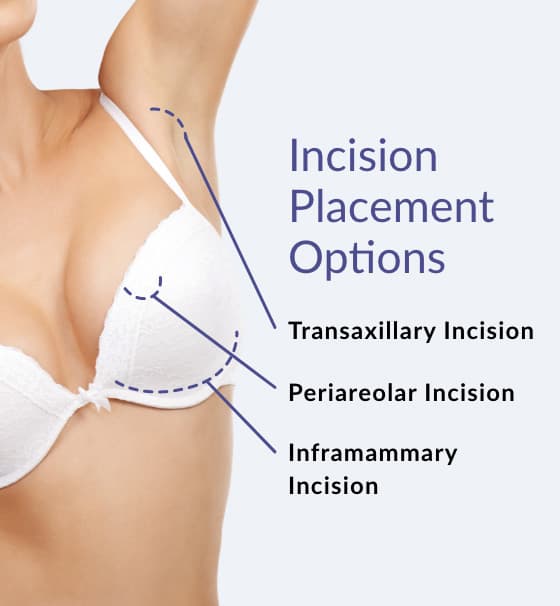incision placement options infographic