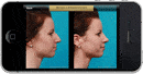 Before and after rhinoplasty photo on app.