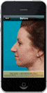 Before rhinoplasty photo on app.