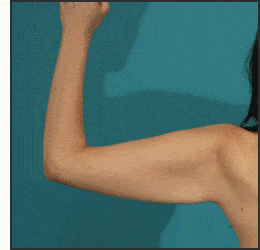 Morph of arm lift before and after photos