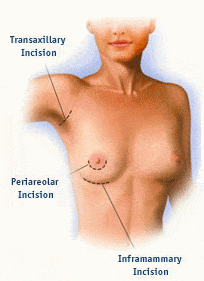 Breast augmentation incision diagram