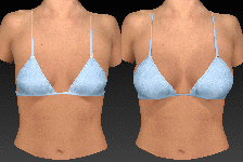 Vectra breast augmentation animation.