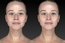 Vectra rhinoplasty animation