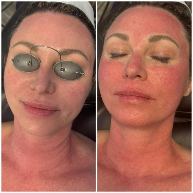 Before and immediately after HALO treatment!

✨What is HALO? ✨

We get tons of questions about our HALO laser and exactly what the benefits are so let’s get some of your questions answered!

A HALO (Hybrid Fractional laser)  is a skin resurfacing treatment that combines both ablative and non-ablative technologies to improve skin texture, tone, and address signs of aging!

What’s the downtime? ✨
The HALO laser requires about 7-10 days of downtime which consists of redness and minimal swelling.

Customization with HALO✨
The HALO lasers, precision and adjustable settings, allow our Aesthetician to tailor the treatment to your individual skin needs and desired results!

Let us know if you have any further questions!
📞817-442-1236

#laser #halo #halolaser #aesthetics